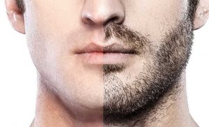 Beard Transplant in Turkey