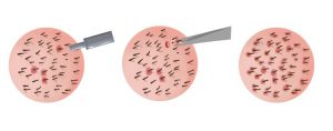 Hair Graft