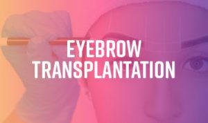 Eyebrow Transplantation