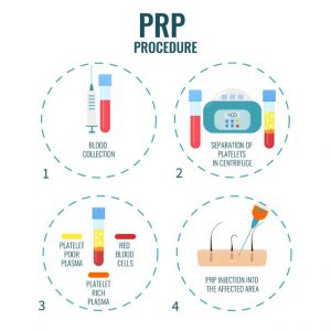 PRP Treatment