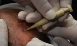 Dhi hair transplant