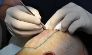 FUE hair transplant