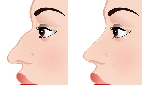 frequently asked questions about rhinoplasty