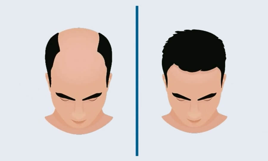 Welche Haartransplantationsmethode ist für Sie am besten geeignet? | FUE oder DHI?