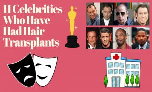 Celebrities Hair Transplantation