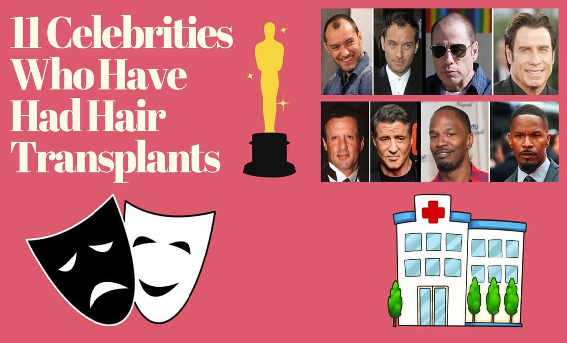 11 Prominente, die Haartransplantationen hatten
