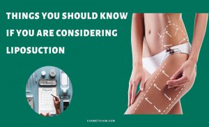 You Should Know About Liposuction