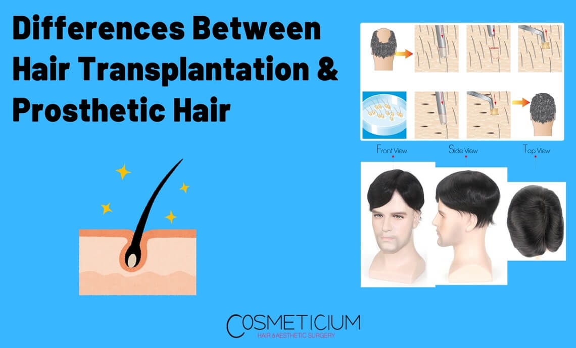 Differences Between Hair Transplantation & Prosthetic Hair