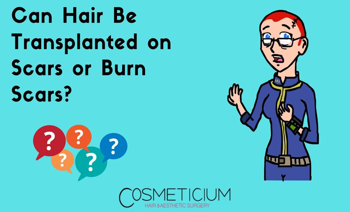 Can Hair Be Transplanted on Scars or Burn Scars?