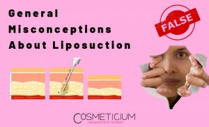Misconceptions About Liposuction
