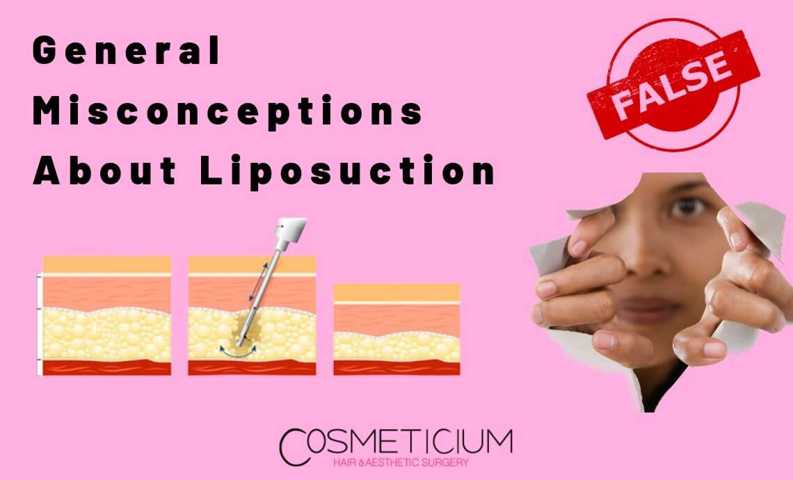 General Misconceptions About Liposuction