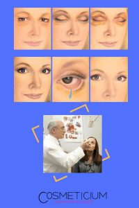 Blepharoplasty Procedure