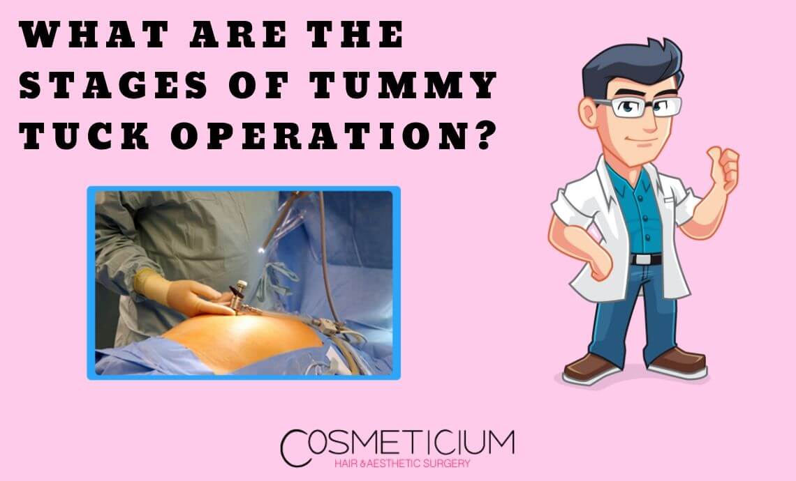 What Are the Stages of Tummy Tuck Operation?
