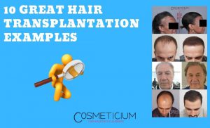 Successful Hair Transplantation Examples