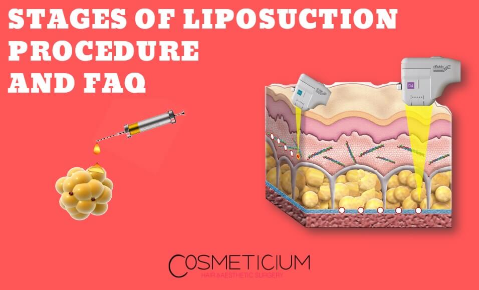 Stages of Liposuction Procedure and Frequently Asked Questions