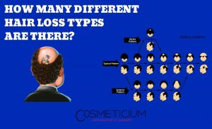 Hair Loss Types