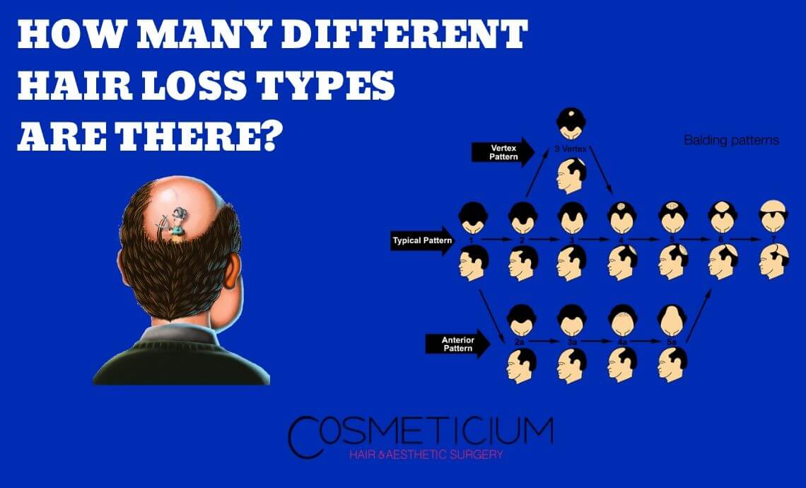 How Many Different Hair Loss Types Are There? Which One Is Yours?