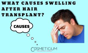 The Main Causes of Swelling After Hair Transplantation