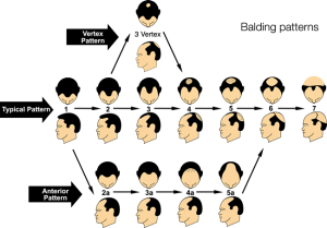 Types of Hair Loss