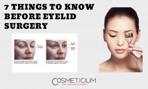Eyelid Surgery