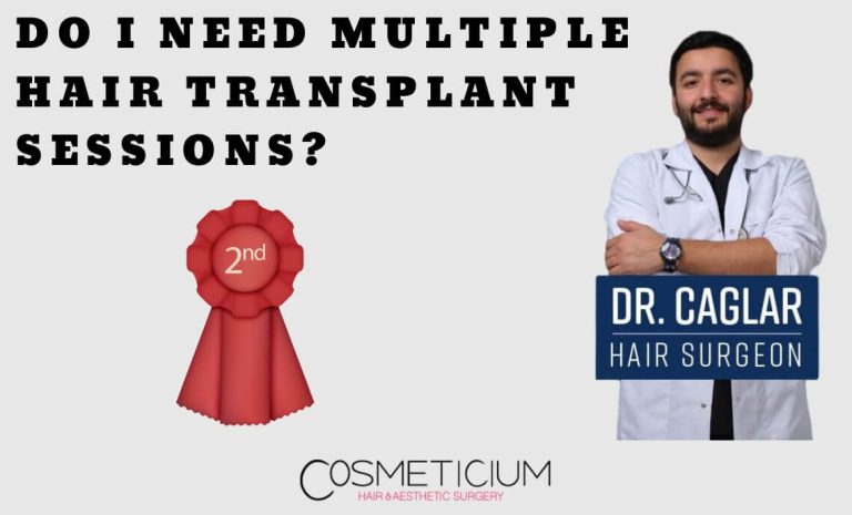 Do I Need Multiple Hair Transplant Sessions? | Cosmeticium