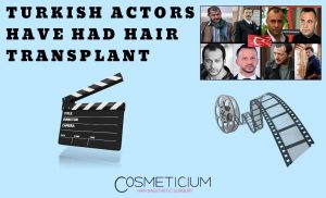 Turkish Actors Have Had Hair Transplantation