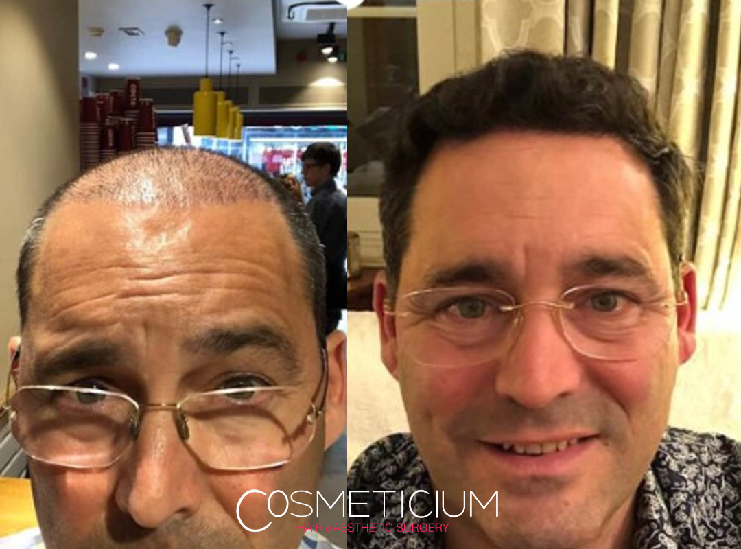 hair transplant before after in turkey
