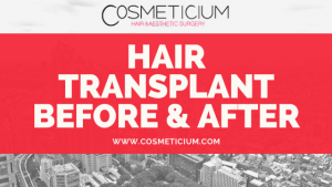 hair transplant before and after