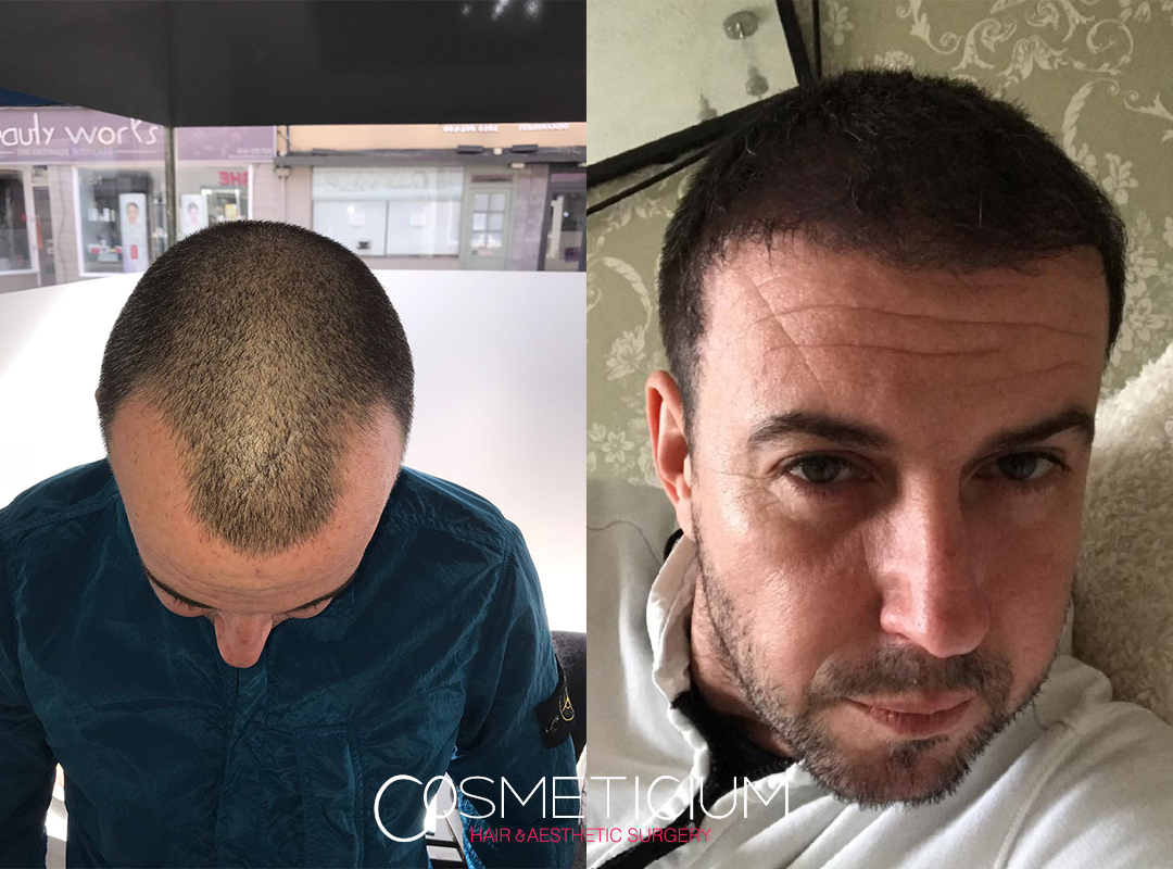 hair transplant before and after