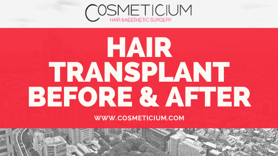 Hair transplant before and after at Cosmeticium in Turkey