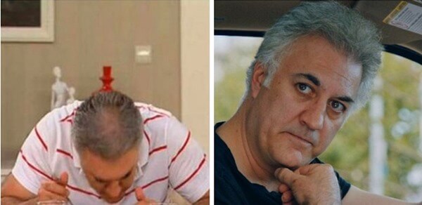 Turkish Actors Hair Transplantation: Tamer Karadağlı