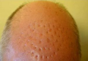 unsuccessful hair transplantation