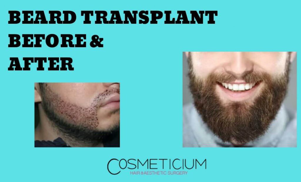 Beard Transplant Before And After Cosmeticium