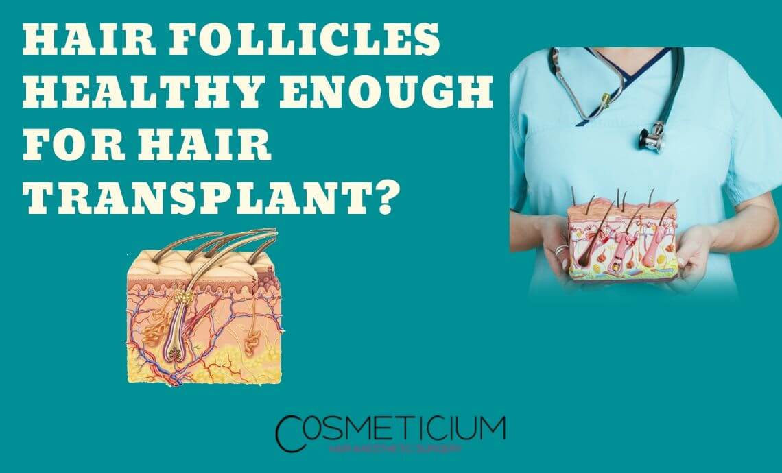 Are Your Hair Follicles Healthy Enough For Hair Transplantation?