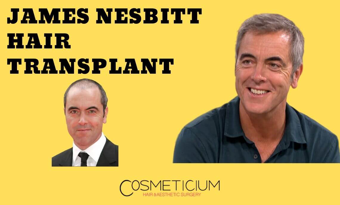 James Nesbitt Hair Transplant | Secret Revealed