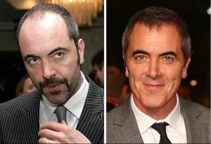 James Nesbitt’s Hair Transplant