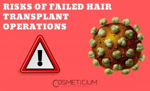 Failed Hair Transplant Results