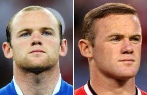 Wayne-Rooney-Hair-Transplant-before-and-after
