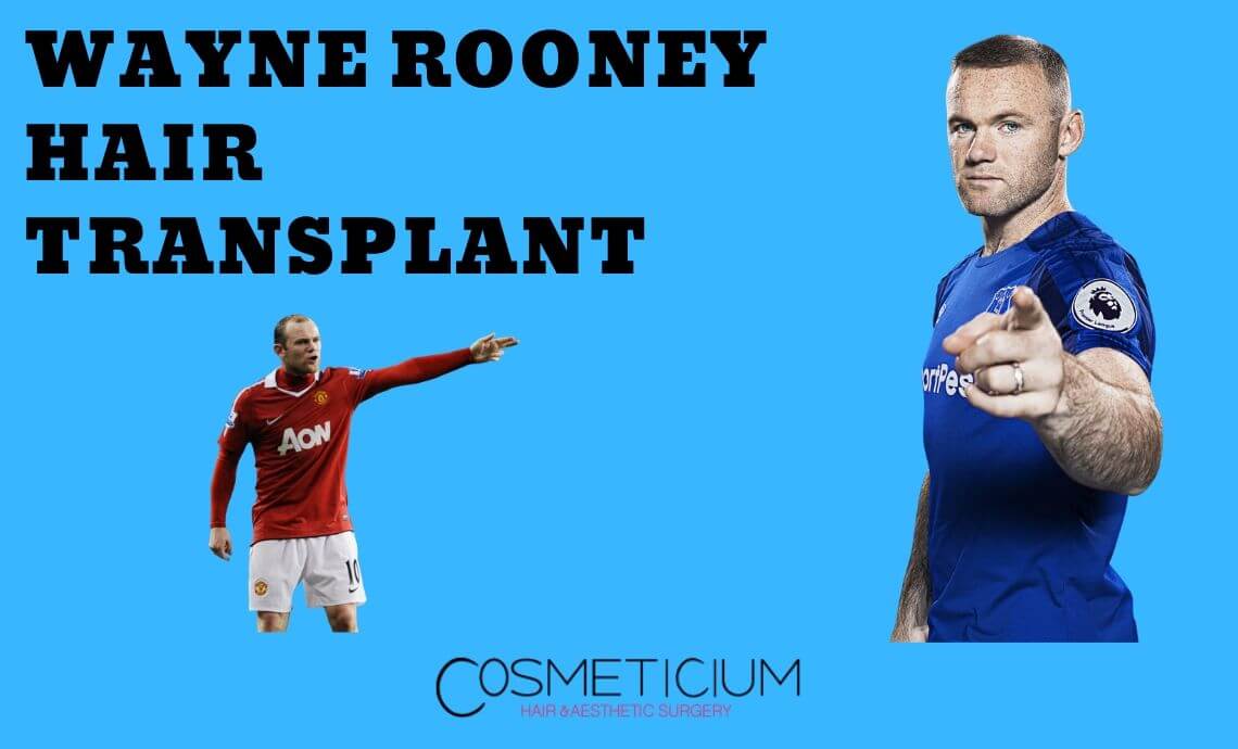 Wayne Rooney Hair Transplantation | Secret Revealed