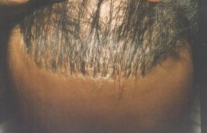 Fail Hair Transplant