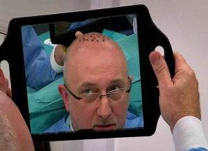 Failed Hair Transplantation