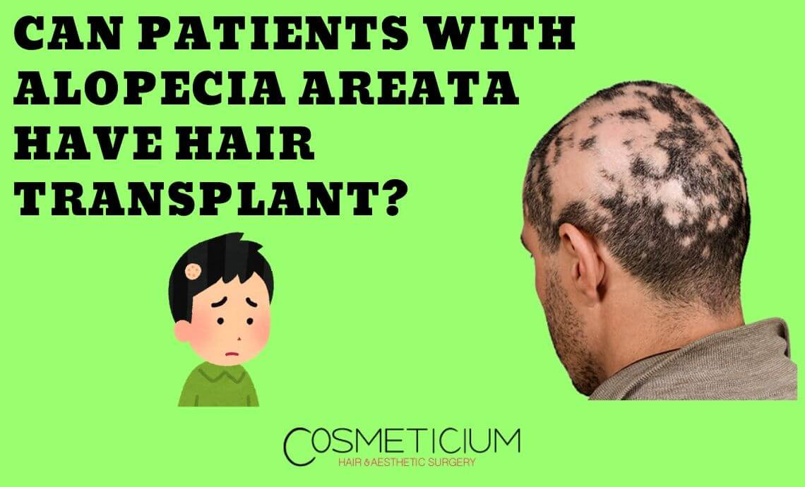 Can Patients with Alopecia Areata Have Hair Transplantation?