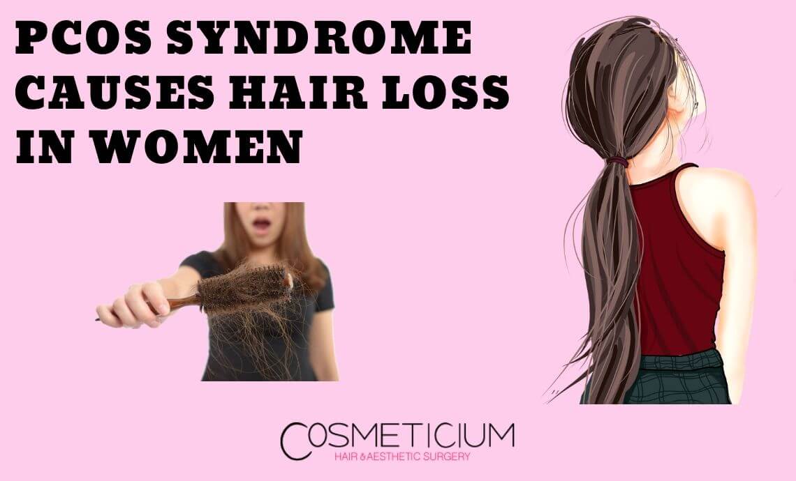 PCOS Syndrome Causes Hair Loss in Women