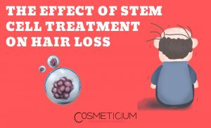 Hair Loss and Stem Cell