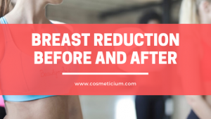 Breast Reduction Before and After