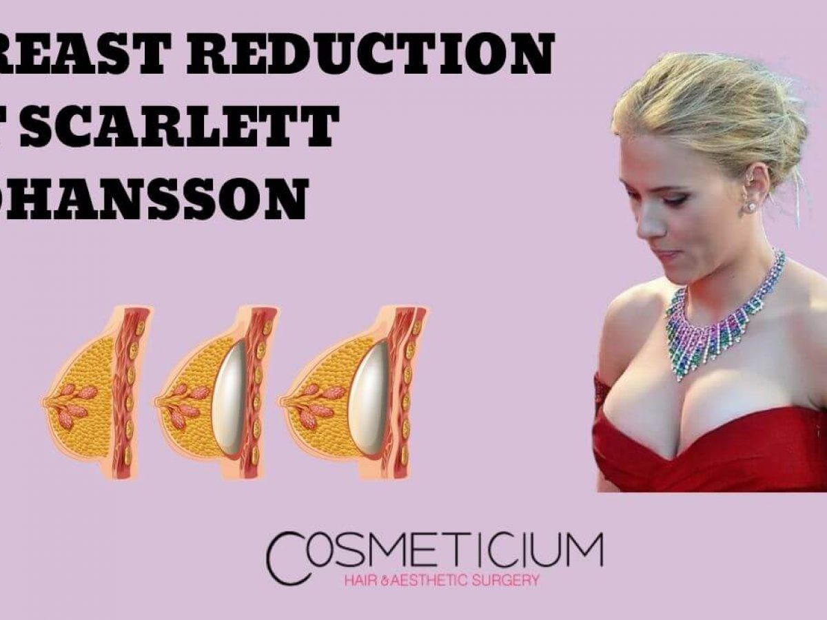 Scarlett johansson before breast reduction