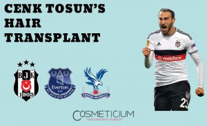 Cenk Tosun Hair Transplant