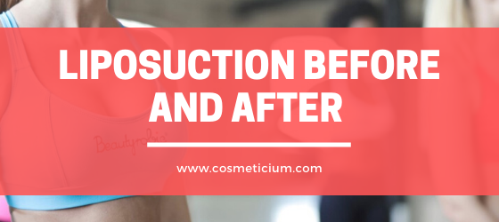 Liposuction Before and After 