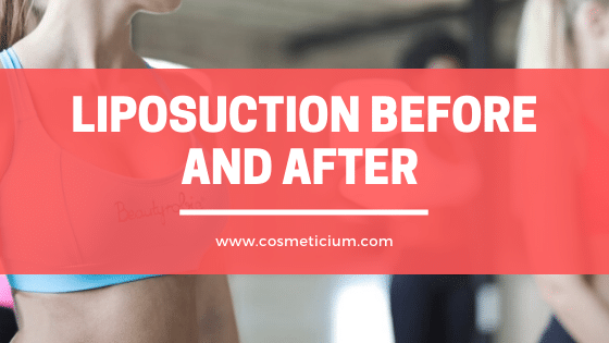 Liposuction Before and After 