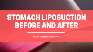 Stomach Liposuction Before and After